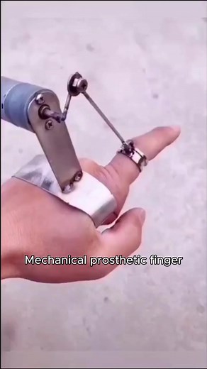 Mechanical Finger Prosthesis Innovations in Engineering