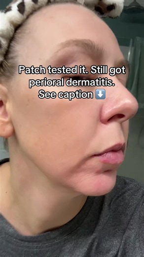 It burns and itches!! it’s not acne. A patch test is designed to identify allergic contact dermatitis (delayed allergic reactions), whereas perioral dermatitis is a distinct inflammatory condition.Because perioral dermatitis is not an allergic reaction, patch testing cannot prevent it. It isn’t always possible to determine the cause. Many things can cause a flare like steroids, fluoride, toothpaste, retinoids, or tretinoin, salicylic acid, glycolic acid, any chemical peel, latex, fragrances, the