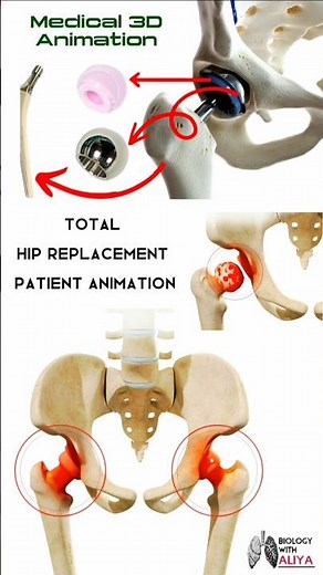 Total Hip Replacement Patient Animation #hipreplacement #shorts