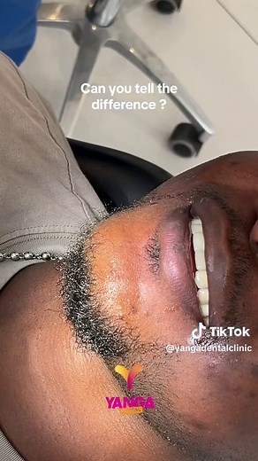 Affordable Tooth Replacement Solutions at Yanga Dental Clinic