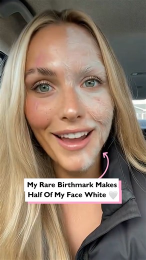 My rare birthmark makes half my face white 🤍 This nevus isn't just a birthmark, it’s a visual reminder that beauty doesn't follow a template. My face tells a story of rarity and light, and I’m here for every chapter. ✨ #fblifestyle #uniquebeauty #ai | Four Nine