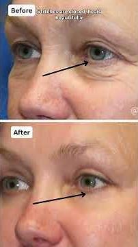 3 Reasons Your Eyes Look Tired & The Procedures I Do to Fix it