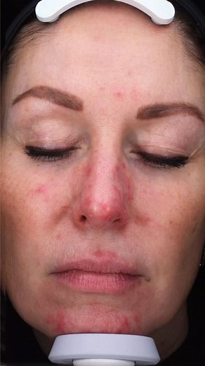 Claudia liep al 1,5 jaar rond met huidklachten, maar helaas kon niemand haar helpen. Uiteindelijk kwam ze bij het Skincare Centre terecht. Bij Claudia bleek er sprake te zijn van een overgroei van de demodexmijt. Deze mijt kan klachten geven als bultjes en roodheid (rosacea). Om de overgroei van deze mijt tegen te gaan hebben we Ivermectine voorgeschreven. Ook kreeg Claudia medicinale azelaïnezuur, om de roodheid en bultjes te verminderen. Verder gebruikte ze de Cleanser, Toner, Moisturizer en S