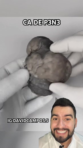 Cáncer de Pene: Penectomía Parcial por Cássio Sales