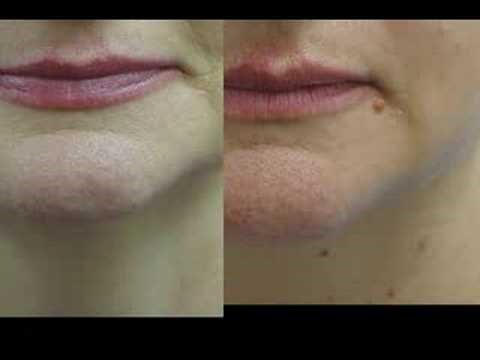 Erbium Laser Resurfacing Before and After Phots