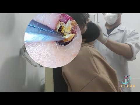 Didn't Expect That Much Earwax - Professional ear care