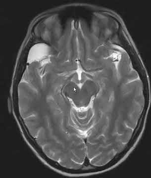 Arachnoid cyst brain