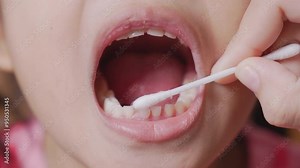 Close-up to Doctor loosens teeth with cotton bud. A beautiful little girl 6-7 years old has a loose tooth, replacement of permanent teeth, dentistry.