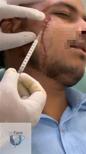 Scar remodeling with intralesional triamcinolone
