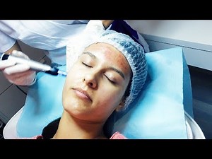 Dermapen Mesotherapy | How Microneedling Treatment Is Done