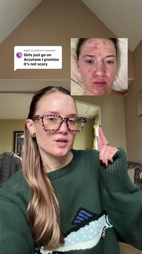 Holistic Healing and Acne Treatment Options