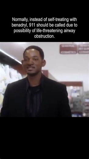 Hitch’s Food Allergic Reaction Explained: When Facial Swelling Is a Medical Emergency