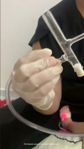 Aspiração nasal não invasiva utilizando o método PROETZ. Você já conhecia??