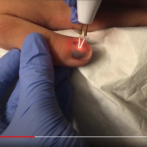 How To Drill A Hole In Your Toenail