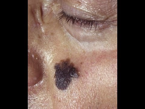 Squamous Cell Carcinoma and Lentigo Maligna Melanoma: plus the pre-cancerous conditions: