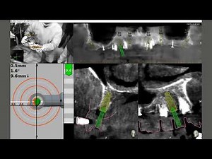Pterygoid implant placement with NAVIDENT, by Dr. Luigi Stefanelli - Roma