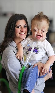 196K views · 5.7K reactions | Three-year-old Raedyn was born with a rare genetic condition called Pfeiffer syndrome, and has had 30 surgeries to date 懶 | Born Different | Facebook