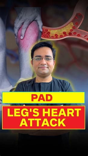 Leg pain or cold feet while walking? It could be Peripheral Arterial Disease (PAD) — the heart attack of the legs. 👨‍⚕️ Dr. Anadi Gupta explains how early diagnosis can prevent serious complications. 📞 For consultations: 08448165444 💬 WhatsApp queries: 09599895081 Save & share this reel so more people can learn about IR ⚠️ Disclaimer: This content is for educational and awareness purposes only. It does not replace medical advice. Please consult your healthcare provider for personalized treatm