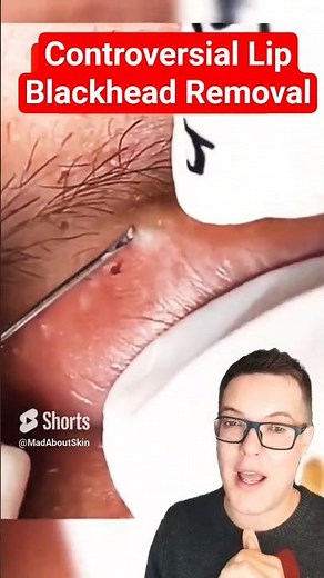 Hugely Controversial BLACKHEAD REMOVAL - What Were They Doing #shorts