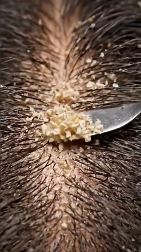 ⚠️ This Will Make You Sleep | ASMR Macro Scalp Scratching & Dandruff Removal