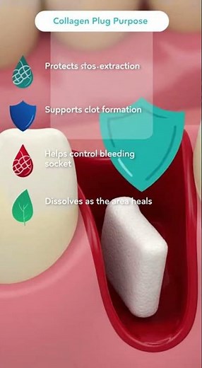 Seeing a white plug in your tooth extraction site? 🤔🦷