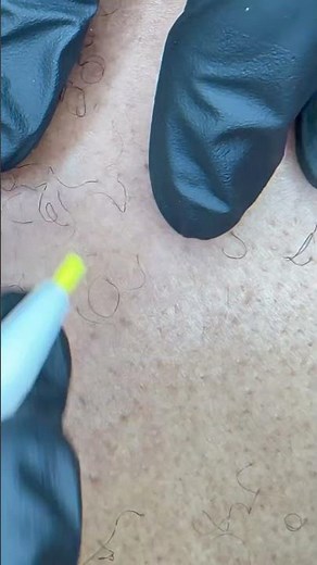 Épilation définitive homme en épilation électrique torse #homme #electrolyse #epilationdefinitive