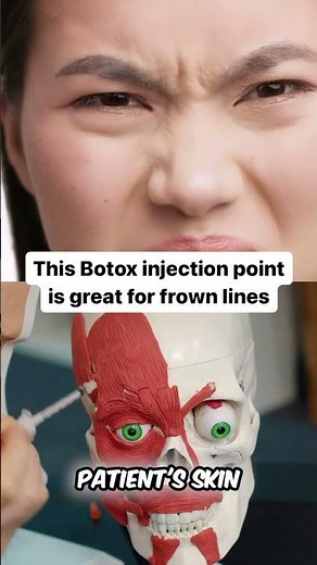 This Botox injection point is great for frown lines