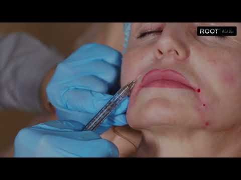 How Botox Fixes Gummy Smiles | Flower Mound/Dallas, TX Guide