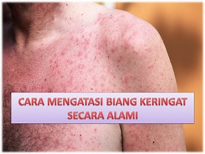 Cara Mengatasi Biang Keringat Secara Alami