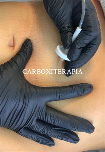 ¡Agenda tu cita de carbox en Body Lab! Y disfruta de los resultados. ✨ #carbox #carboxyterapia #body #spa #fyp