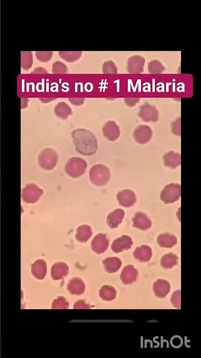 plasmodium vivax.. malaria.. peripheral blood smear.. RMT positive.. parasite