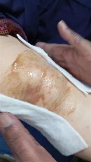 Get rid of knee pain forever