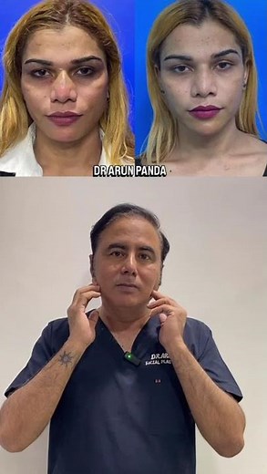 Facial Slimming with Masseter Botox + Chin Filler | Square Jaw Reduction