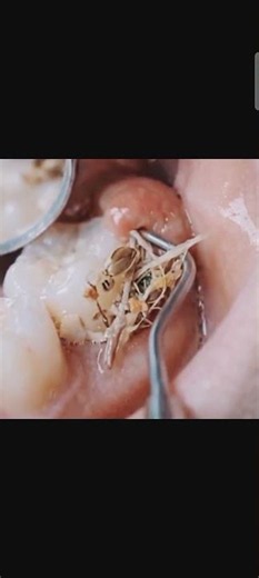 Amazing Deep Teeth Cleaning and Restoration Process