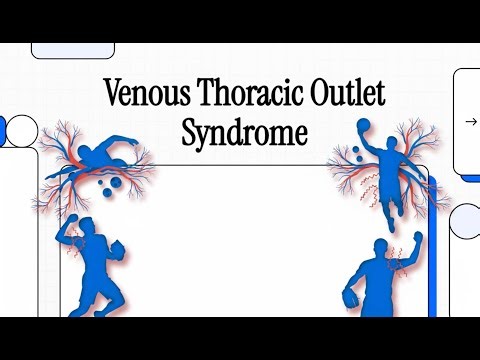 126 Venous Thoracic Outlet Syndrome