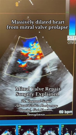 Mitral Valve Repair Explained: A Case Study