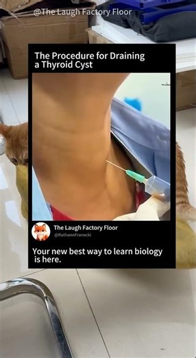 🧪This is how removal of thyroid 💉 cyst fluid is done 🩺| MDCT