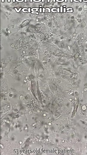 Trichomonas vaginalis #lab #science #medlab #youtube #clinical #microscope #medical