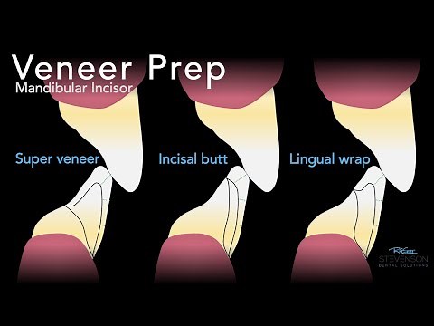 Ceramic Veneer Prep #24 Kilgore 700