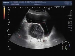 Ultrasound Video showing an ovarian cyst with multiple seedling fibroids.