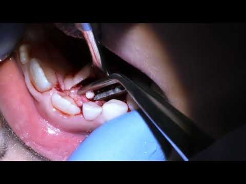 Compound Odontoma removal