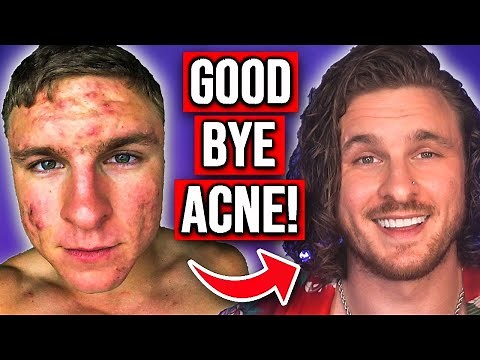 9 Ways To Get Rid of Your Acne (EASY, MEDIUM & HARD)