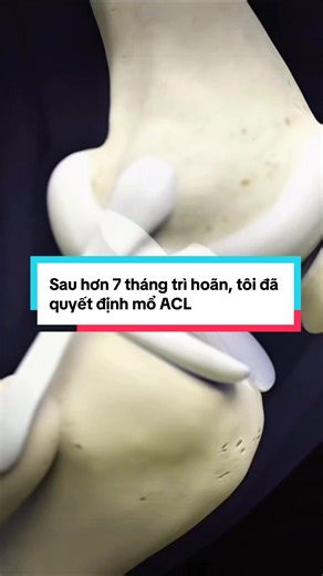 Sau hơn 7 tháng trì hoãn, tôi quyết định mổ ACL. Tôi đã cố tin rằng mình vẫn ổn. Nhưng cơ thể thì không nói dối. Đây là Day 0. 6 tháng nữa tôi sẽ quay lại video này và xem mình đã comeback được bao xa. Nếu bạn cũng đang trì hoãn vì ACL… bạn đã trì hoãn bao lâu rồi? #acljourney #hybridtraining #dutdaychangcheo #xh #aclrehab