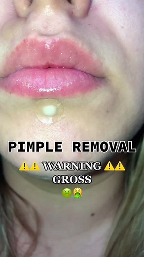 Effective Whitehead Removal Tips and Results