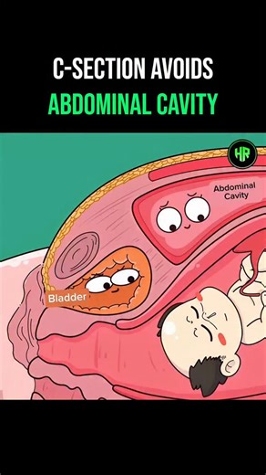 Healthrivex | Daily Health Tips on Instagram: "This animated video illustrates the mechanics of an extraperitoneal Cesarean section, a surgical method that delivers a baby without opening the main abdominal cavity. The clip humorously depicts the procedure from the perspective of the internal organs, specifically highlighting the bladder getting squished as the surgeon navigates around the peritoneum to reach the uterus. While the father is impressed by the unique technique, the doctor clarifies
