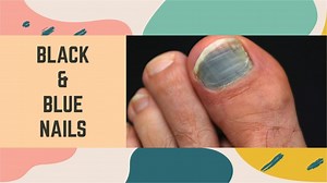 Black and Blue Nails: A Comprehensive Medical Guide to Causes, Treatment, and Prevention | My Clean Nails