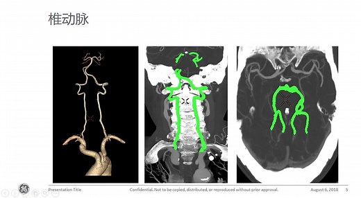 GE头颈部CTA扫描操作及后处理