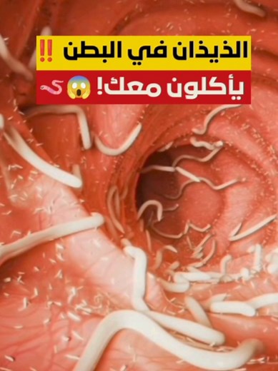 الديدان في البطن: أعراضها وطرق الوقاية والعلاج