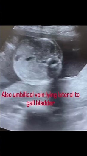 #persistent right umbilical vein #medicaleducation #ultrasound #radiology #fetalmedicine #fetal