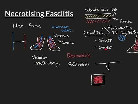 Necrotising Fasciitis